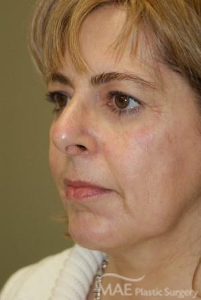 Facelift Before & After Gallery - Patient 292160 - Image 3