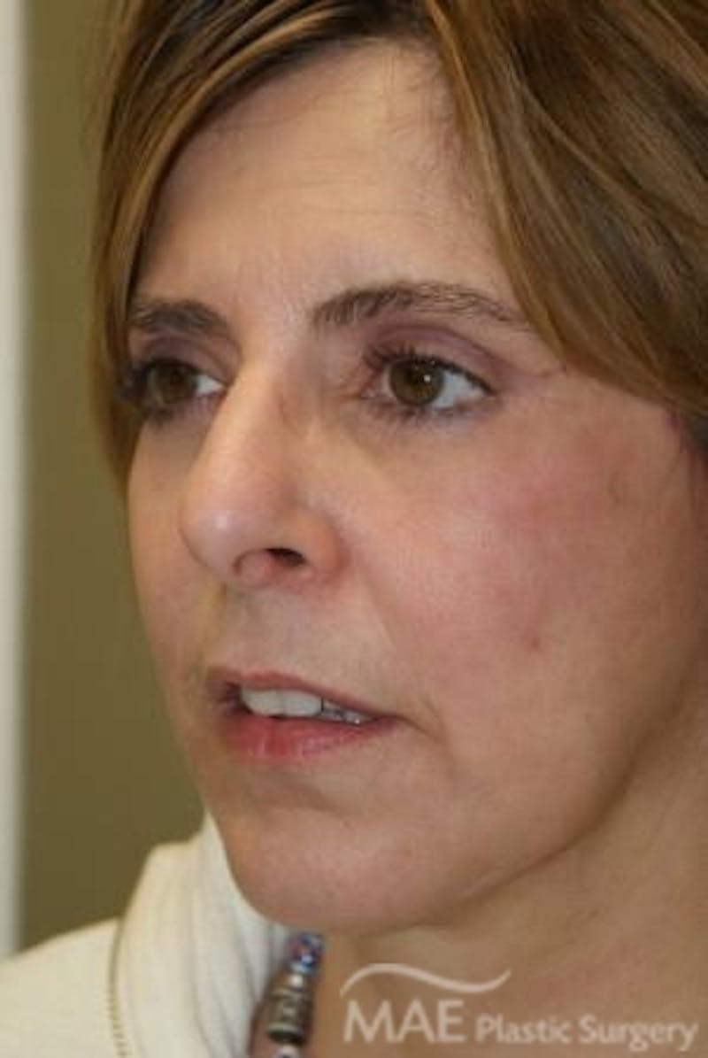 Facelift Before & After Gallery - Patient 292160 - Image 4