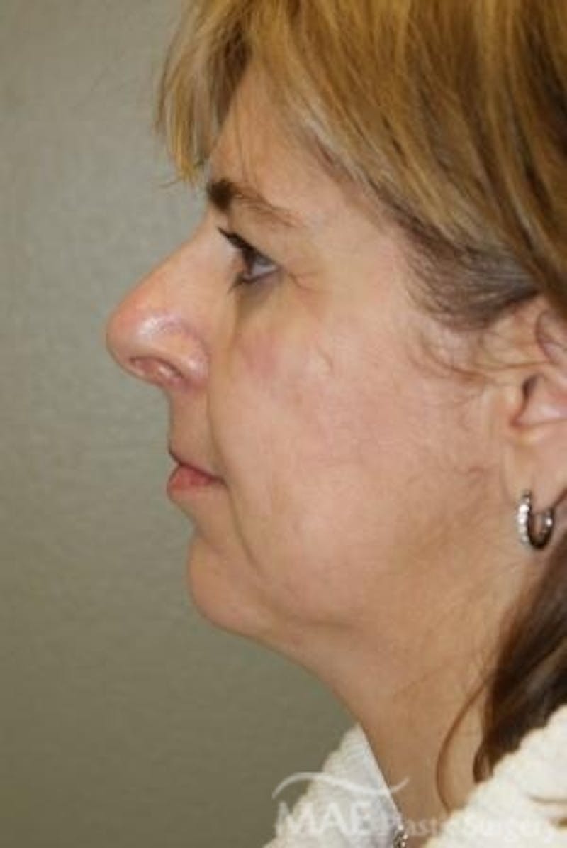 Facelift Before & After Gallery - Patient 292160 - Image 5