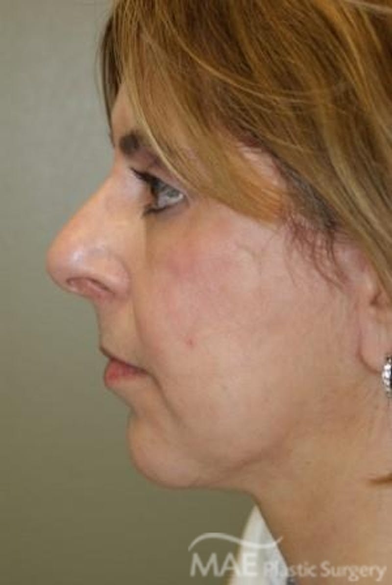 Facelift Before & After Gallery - Patient 292160 - Image 6