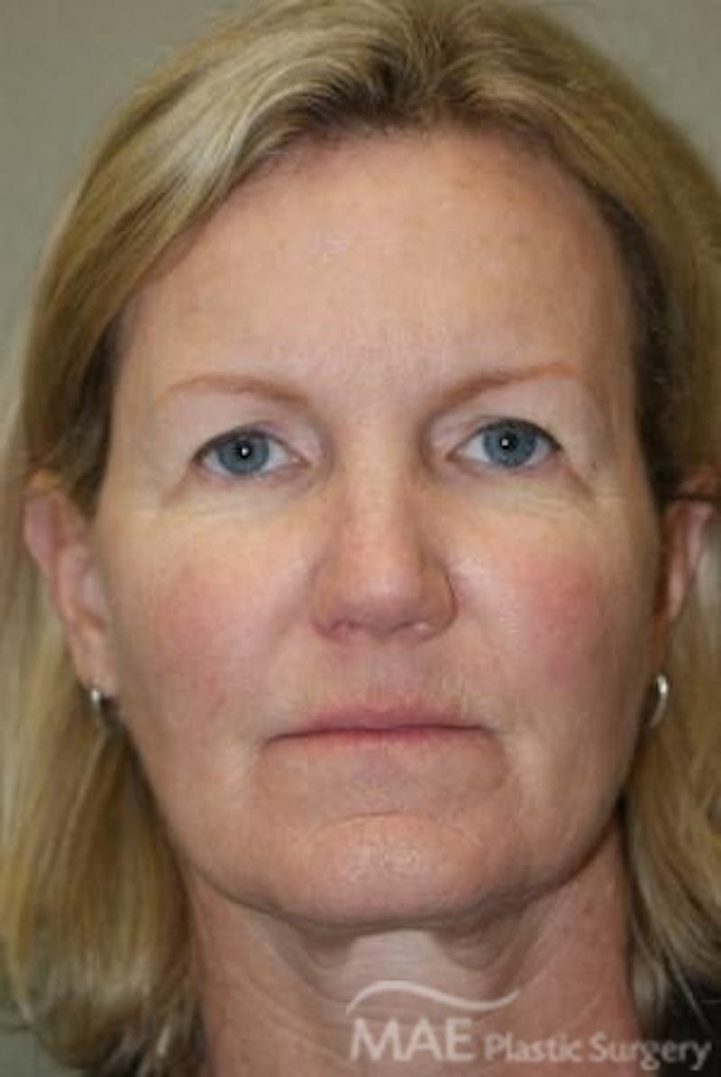 Facelift Before & After Gallery - Patient 301260 - Image 1