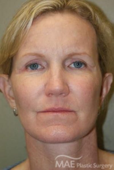 Facelift Before & After Gallery - Patient 301260 - Image 2