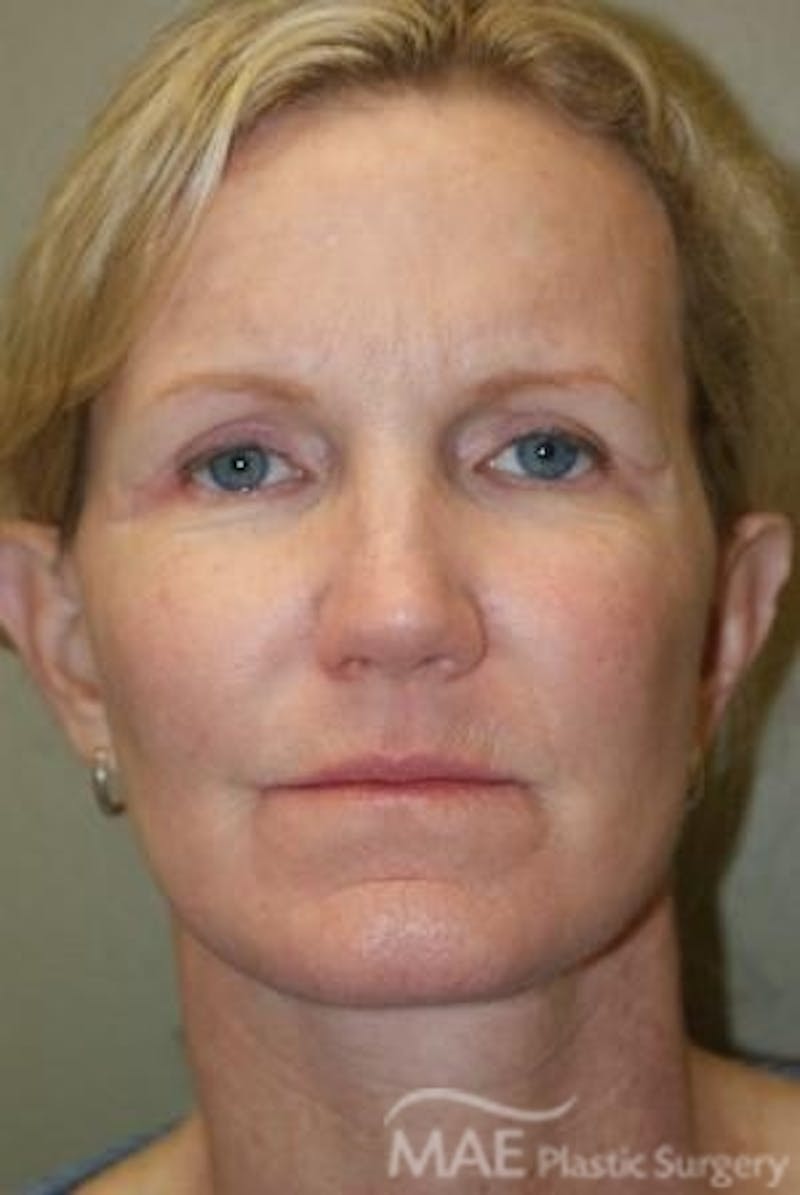Facelift Before & After Gallery - Patient 301260 - Image 2