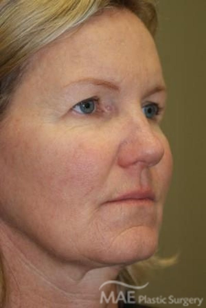 Facelift Before & After Gallery - Patient 301260 - Image 3