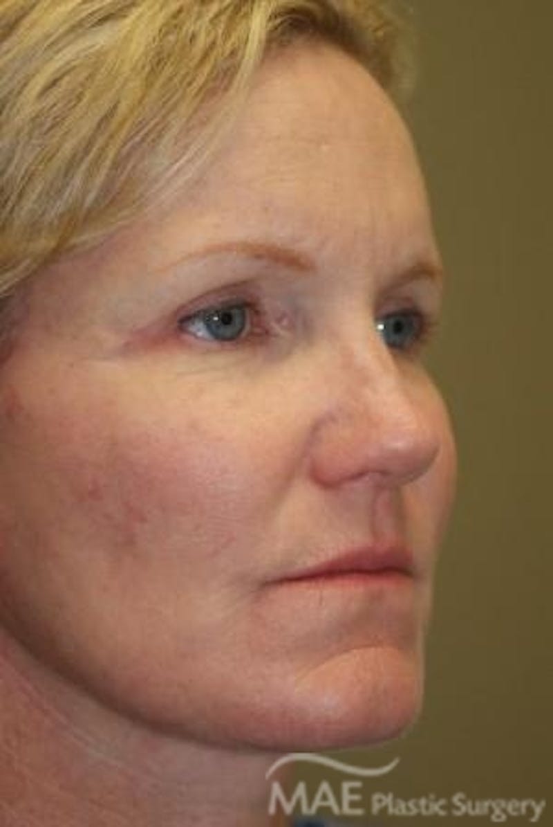 Facelift Before & After Gallery - Patient 301260 - Image 4