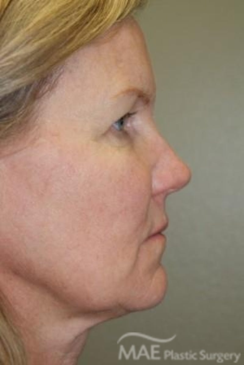 Facelift Before & After Gallery - Patient 301260 - Image 5