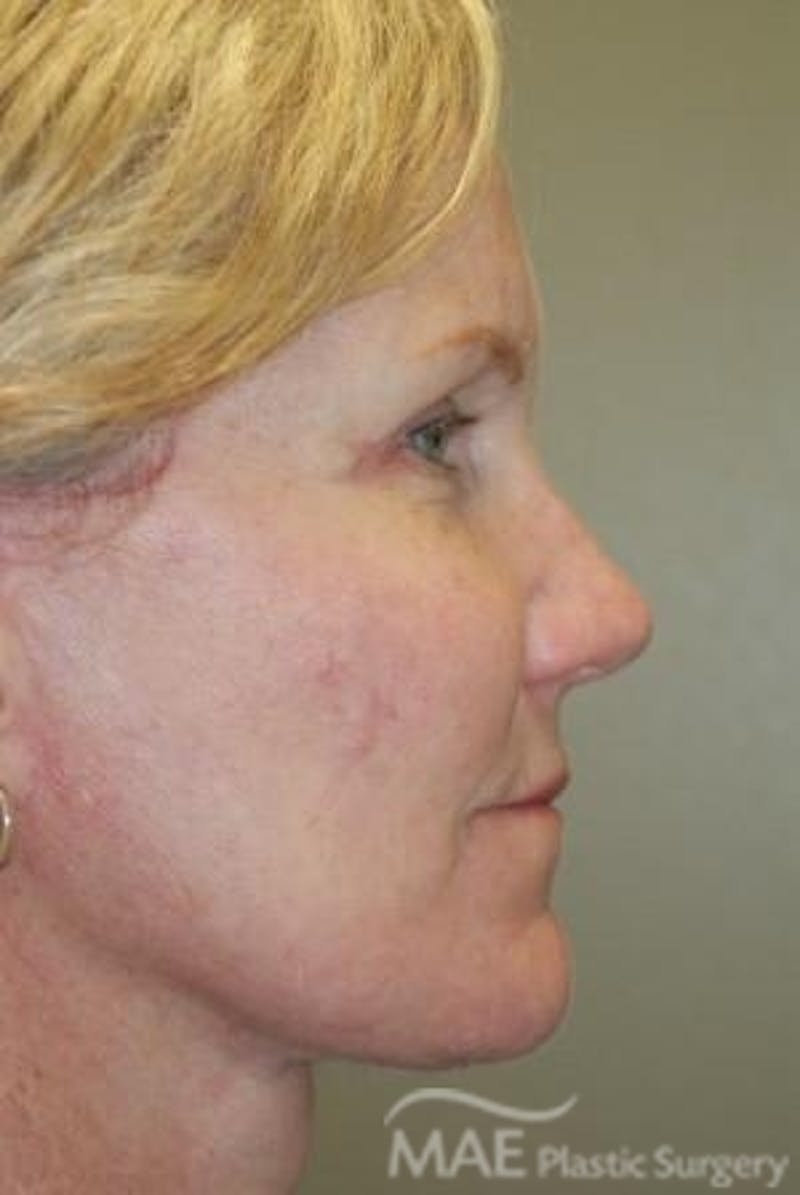 Facelift Before & After Gallery - Patient 301260 - Image 6