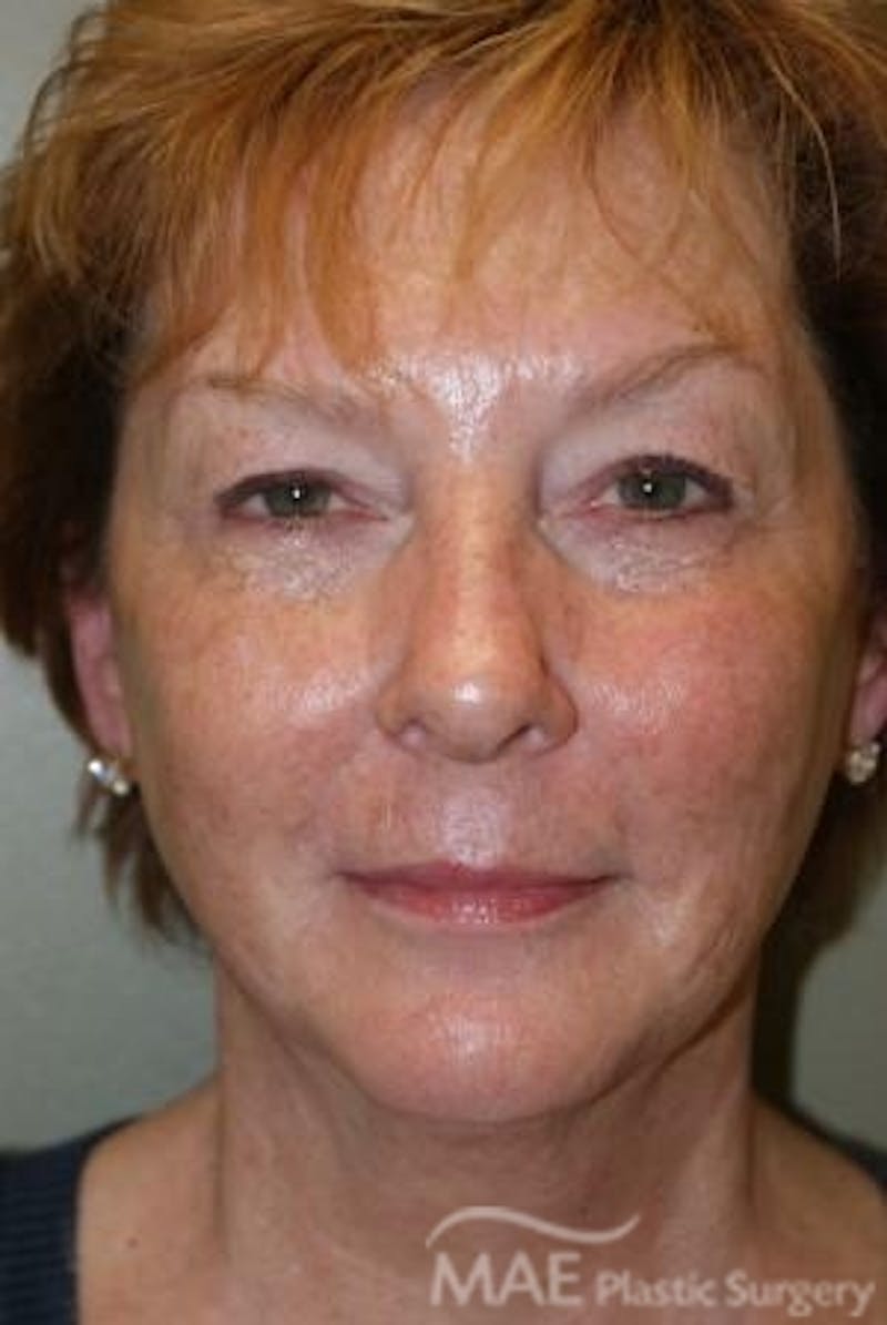 Facelift Before & After Gallery - Patient 613876 - Image 1