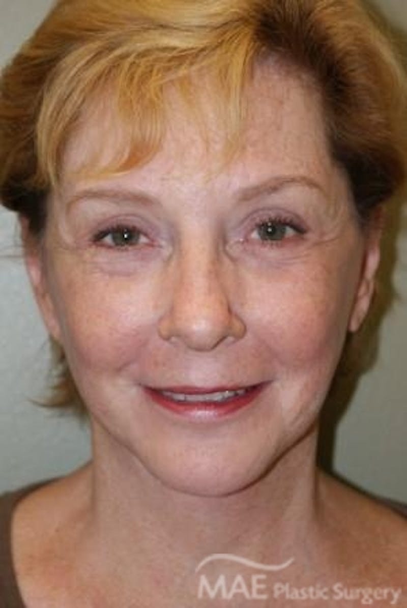 Facelift Before & After Gallery - Patient 613876 - Image 2
