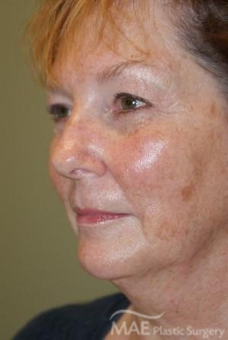 Facelift Before & After Gallery - Patient 613876 - Image 3