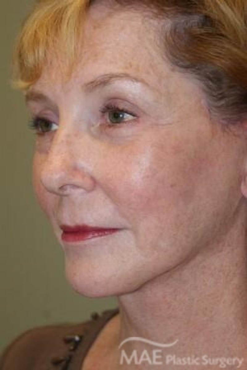 Facelift Before & After Gallery - Patient 613876 - Image 4