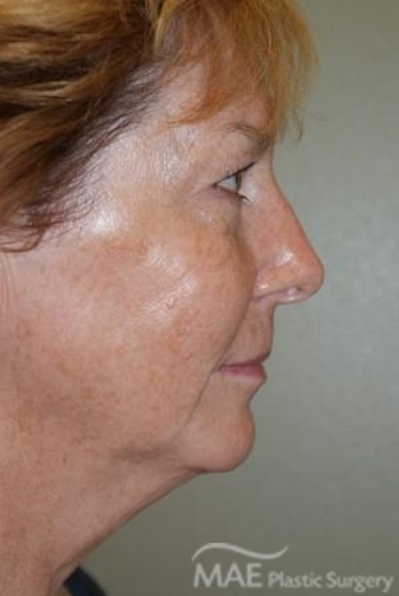 Facelift Before & After Gallery - Patient 613876 - Image 5