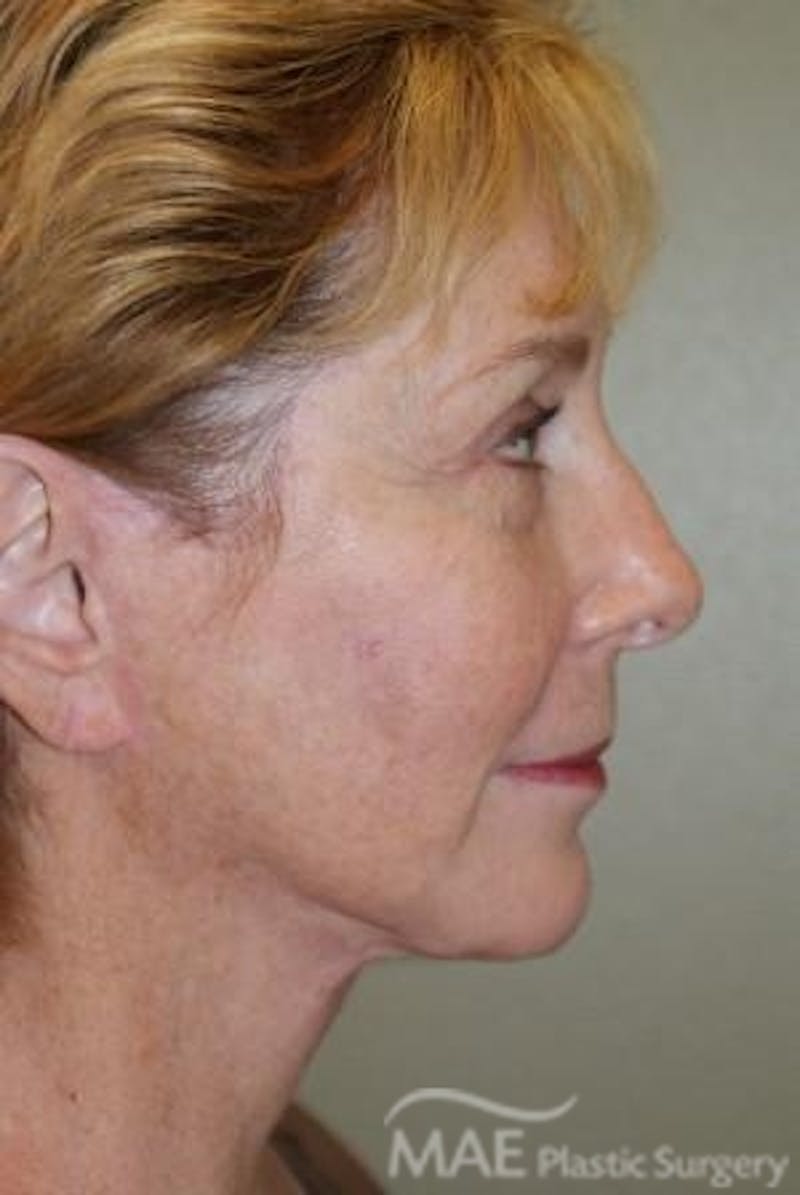 Facelift Before & After Gallery - Patient 613876 - Image 6