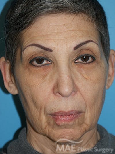 Facelift Before & After Gallery - Patient 159969 - Image 1