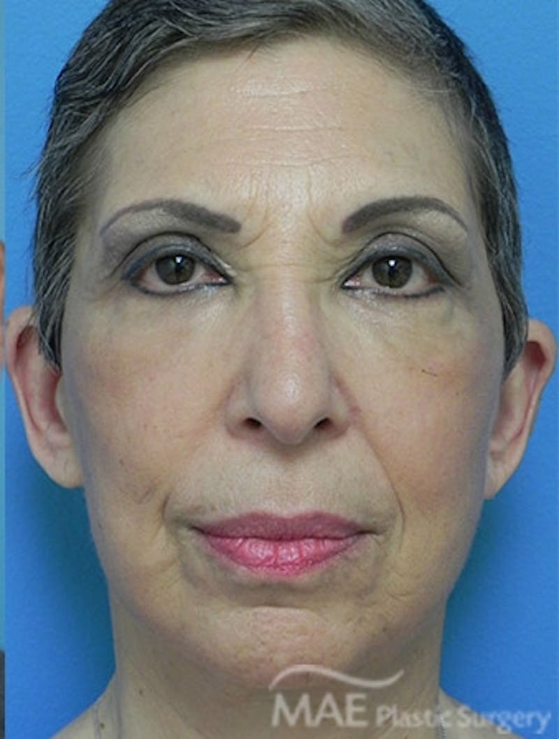 Facelift Before & After Gallery - Patient 159969 - Image 2
