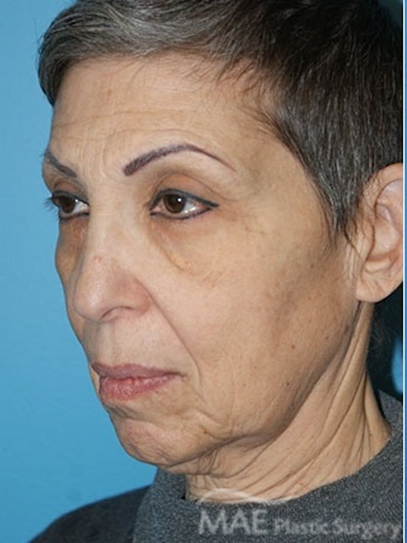 Facelift Before & After Gallery - Patient 159969 - Image 3