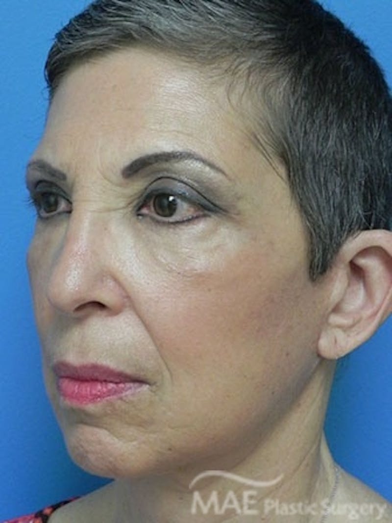 Facelift Before & After Gallery - Patient 159969 - Image 4