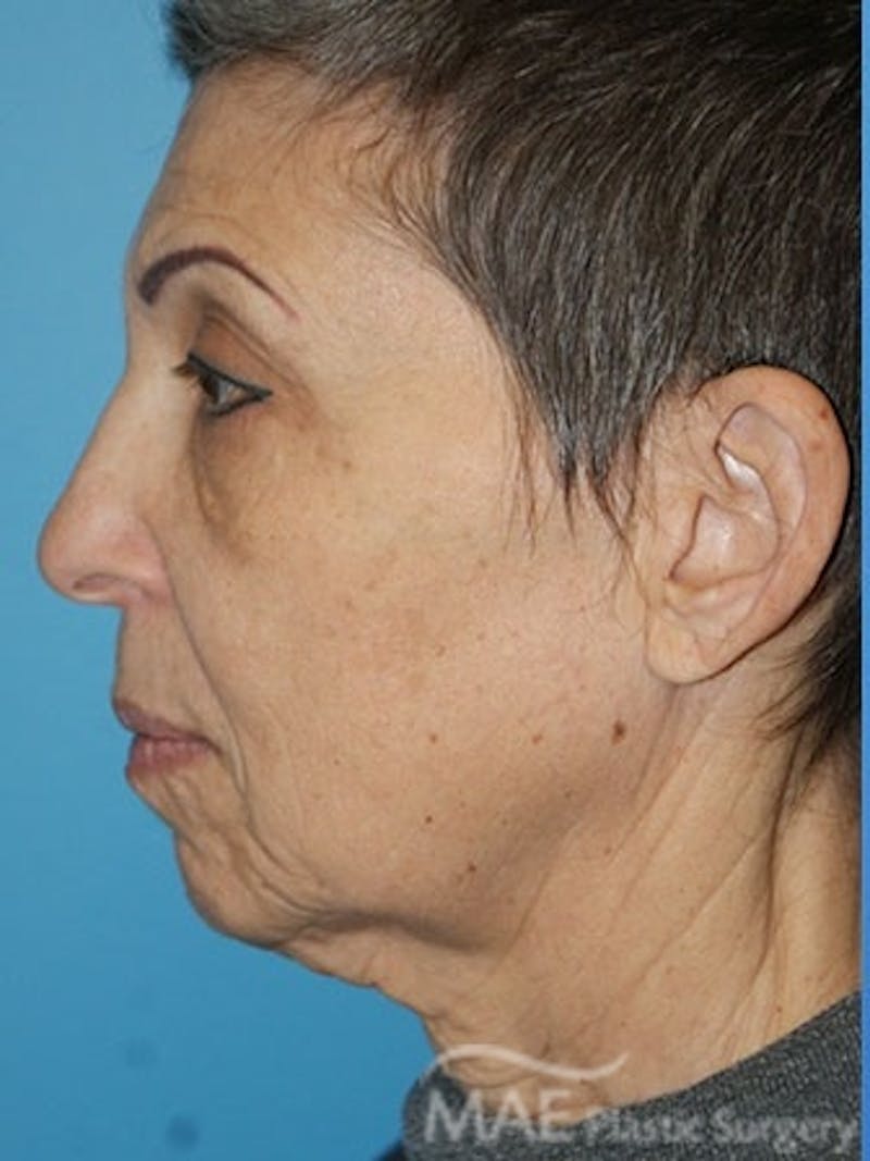 Facelift Before & After Gallery - Patient 159969 - Image 5