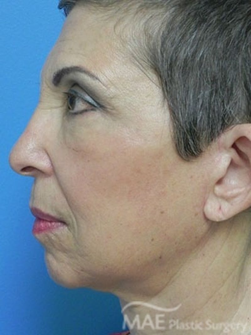 Facelift Before & After Gallery - Patient 159969 - Image 6