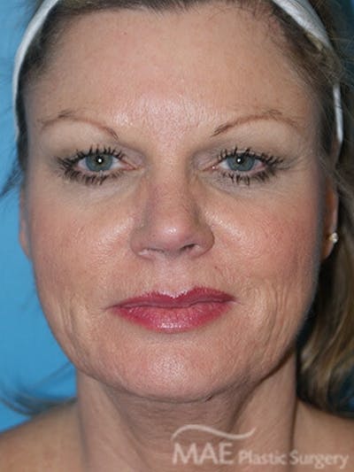 Facelift Before & After Gallery - Patient 260476 - Image 1