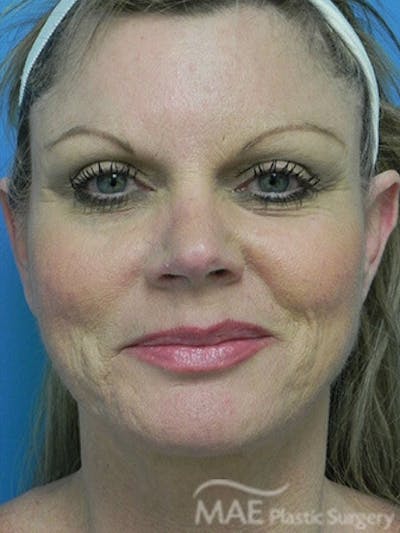 Facelift Before & After Gallery - Patient 260476 - Image 2