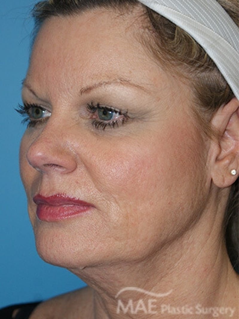Facelift Before & After Gallery - Patient 260476 - Image 3