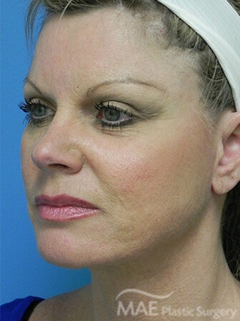 Facelift Before & After Gallery - Patient 260476 - Image 4