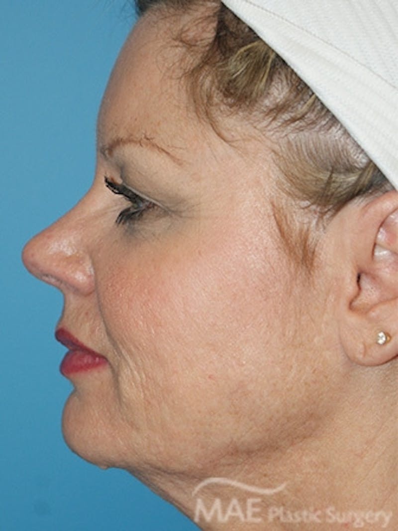 Facelift Before & After Gallery - Patient 260476 - Image 5