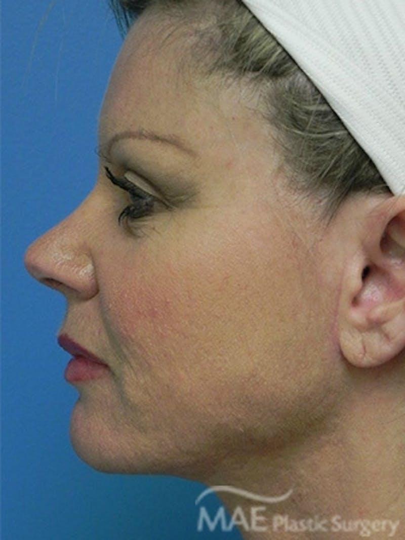 Facelift Before & After Gallery - Patient 260476 - Image 6