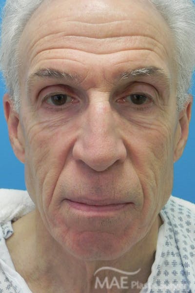 Facelift Before & After Gallery - Patient 481504 - Image 1