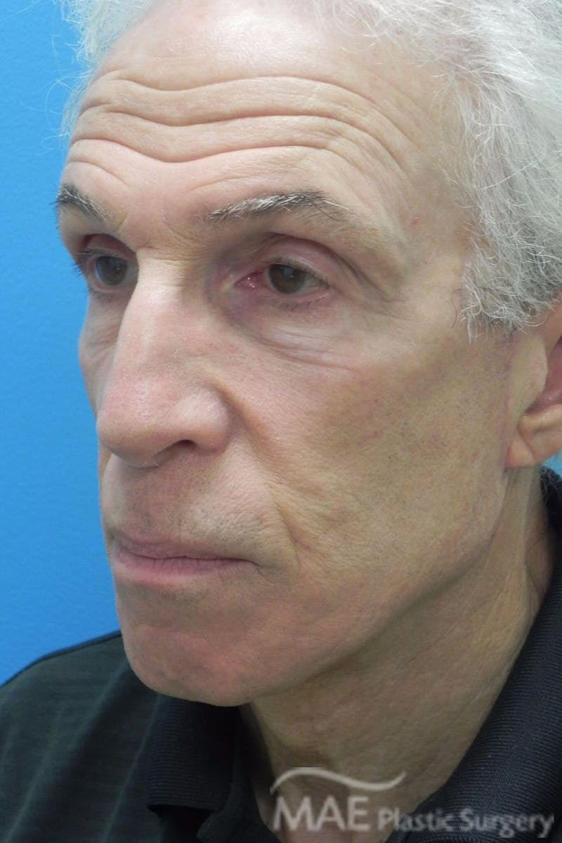 Facelift Before & After Gallery - Patient 481504 - Image 4