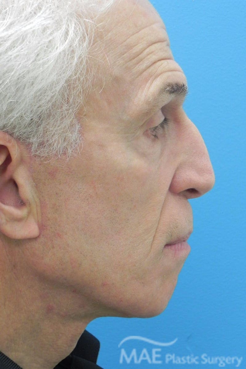 Facelift Before & After Gallery - Patient 481504 - Image 6