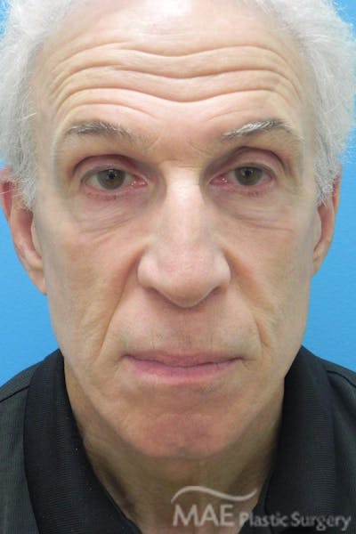 Facelift Before & After Gallery - Patient 481504 - Image 2