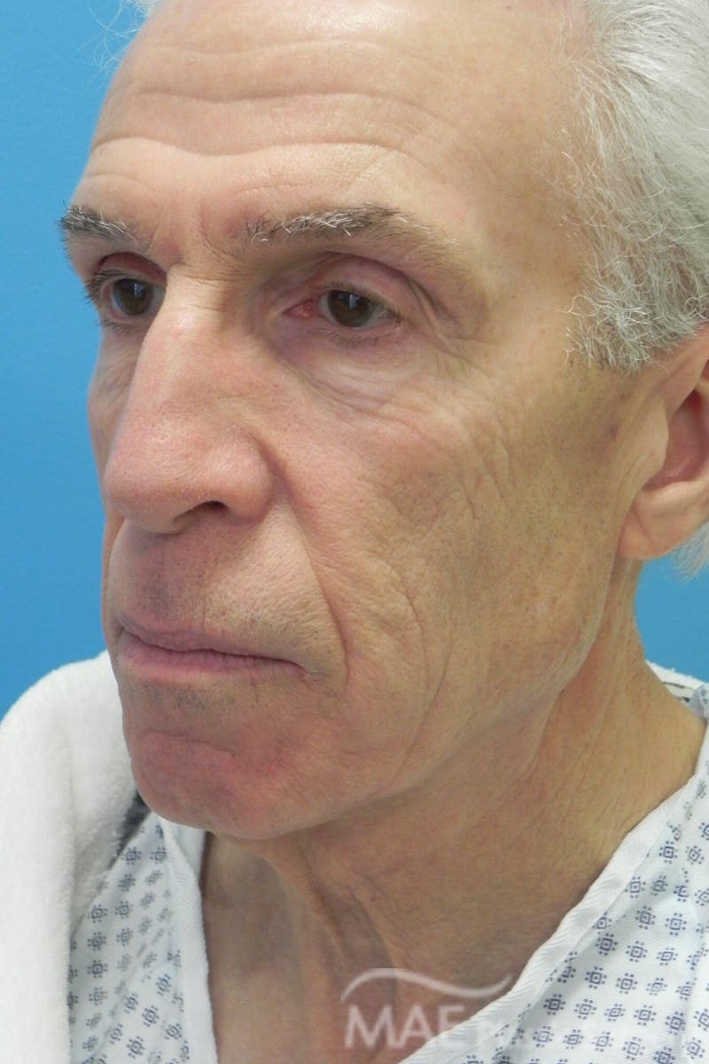 Facelift Before & After Gallery - Patient 481504 - Image 3