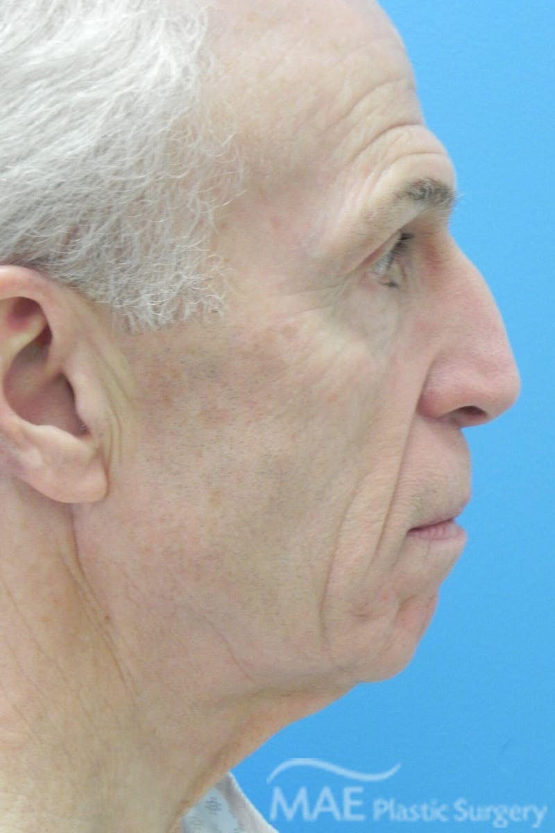 Facelift Before & After Gallery - Patient 481504 - Image 5