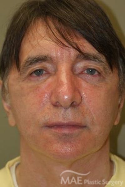 Facelift Before & After Gallery - Patient 418855 - Image 2
