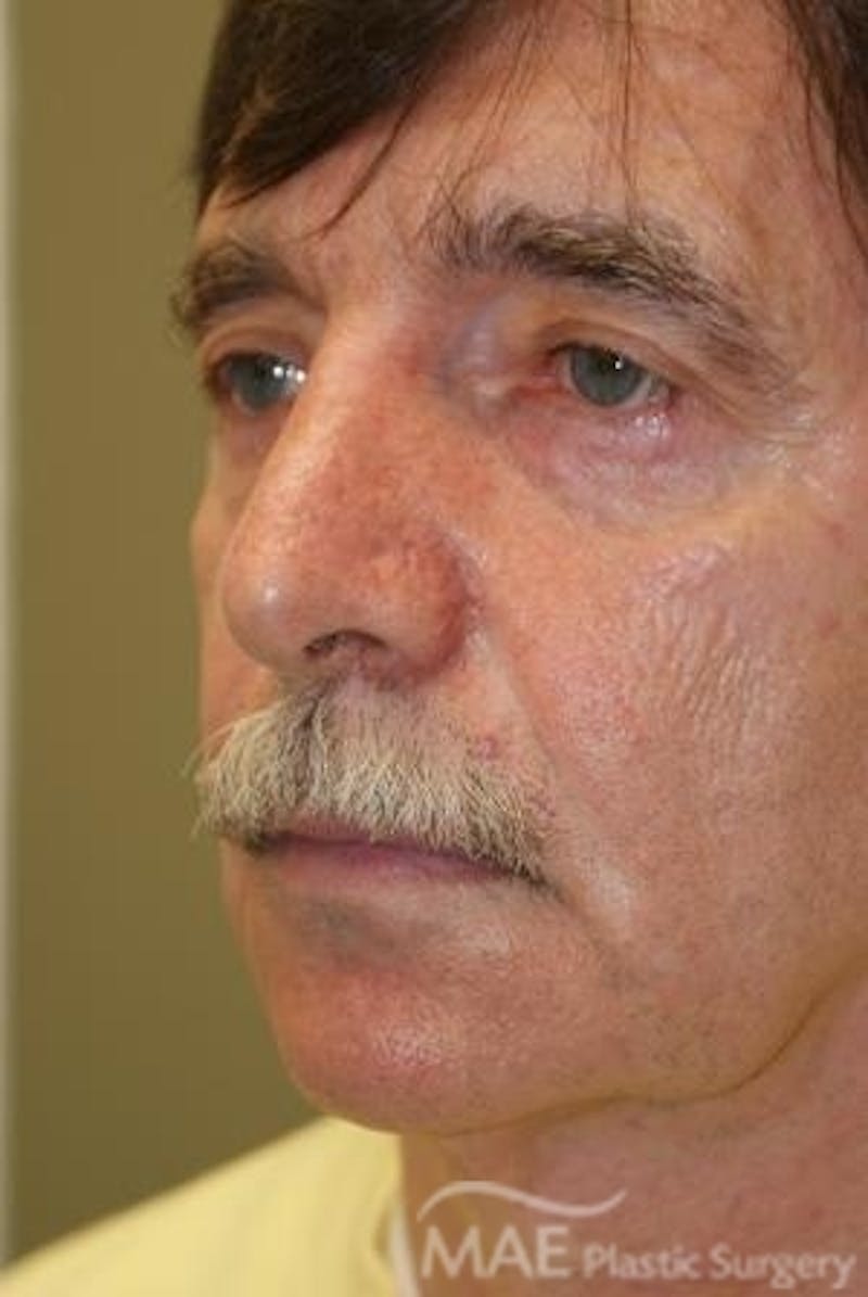 Facelift Before & After Gallery - Patient 418855 - Image 3