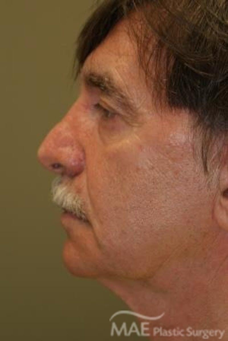 Facelift Before & After Gallery - Patient 418855 - Image 5