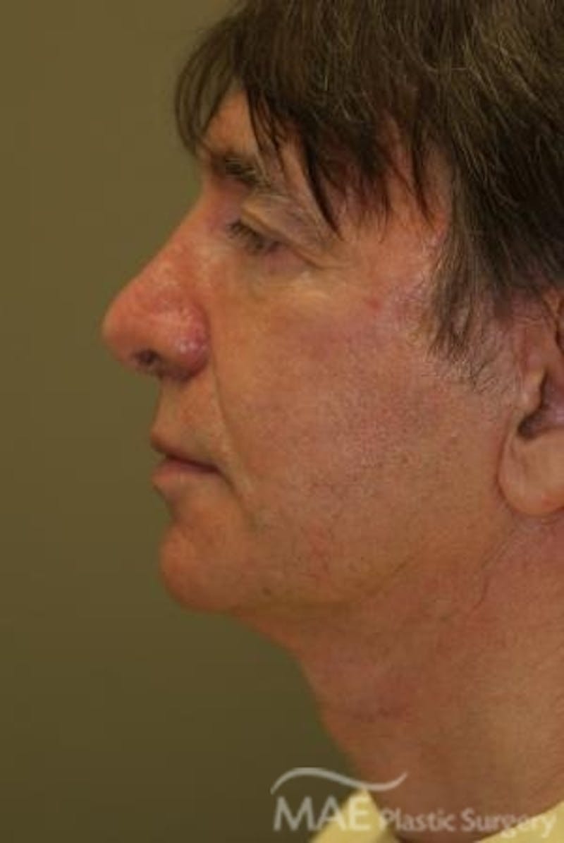 Facelift Before & After Gallery - Patient 418855 - Image 6