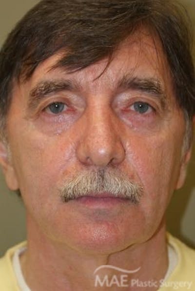 Facelift Before & After Gallery - Patient 418855 - Image 1