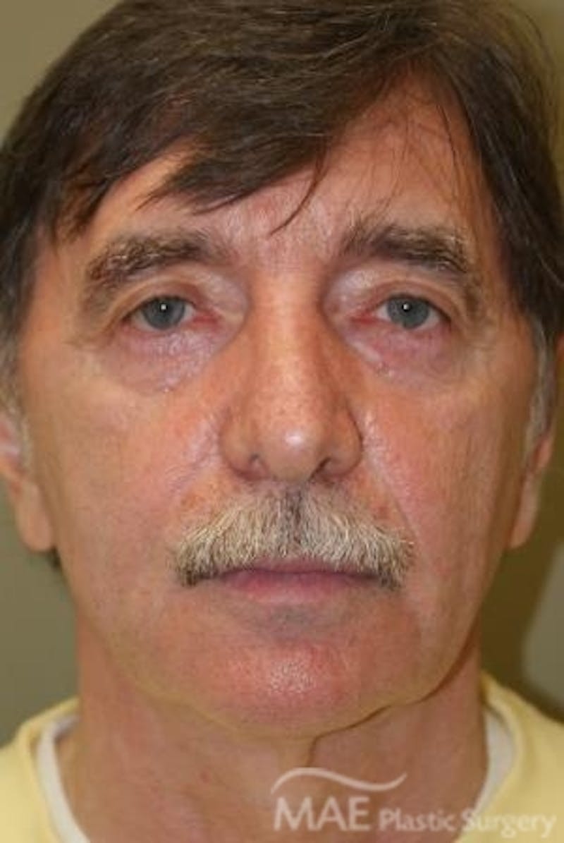 Facelift Before & After Gallery - Patient 418855 - Image 1