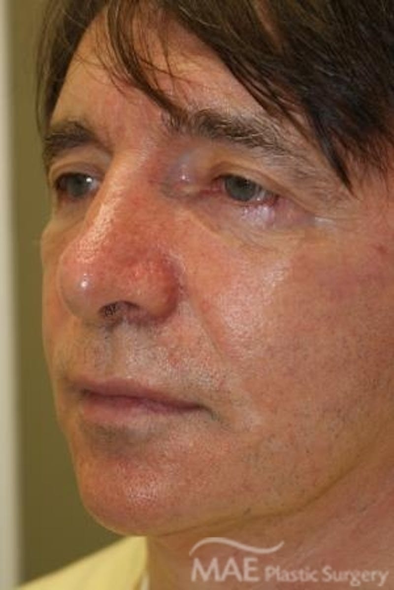 Facelift Before & After Gallery - Patient 418855 - Image 4
