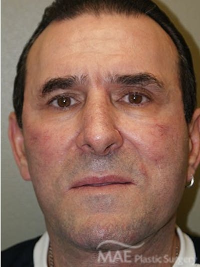 Facelift Before & After Gallery - Patient 127049 - Image 2