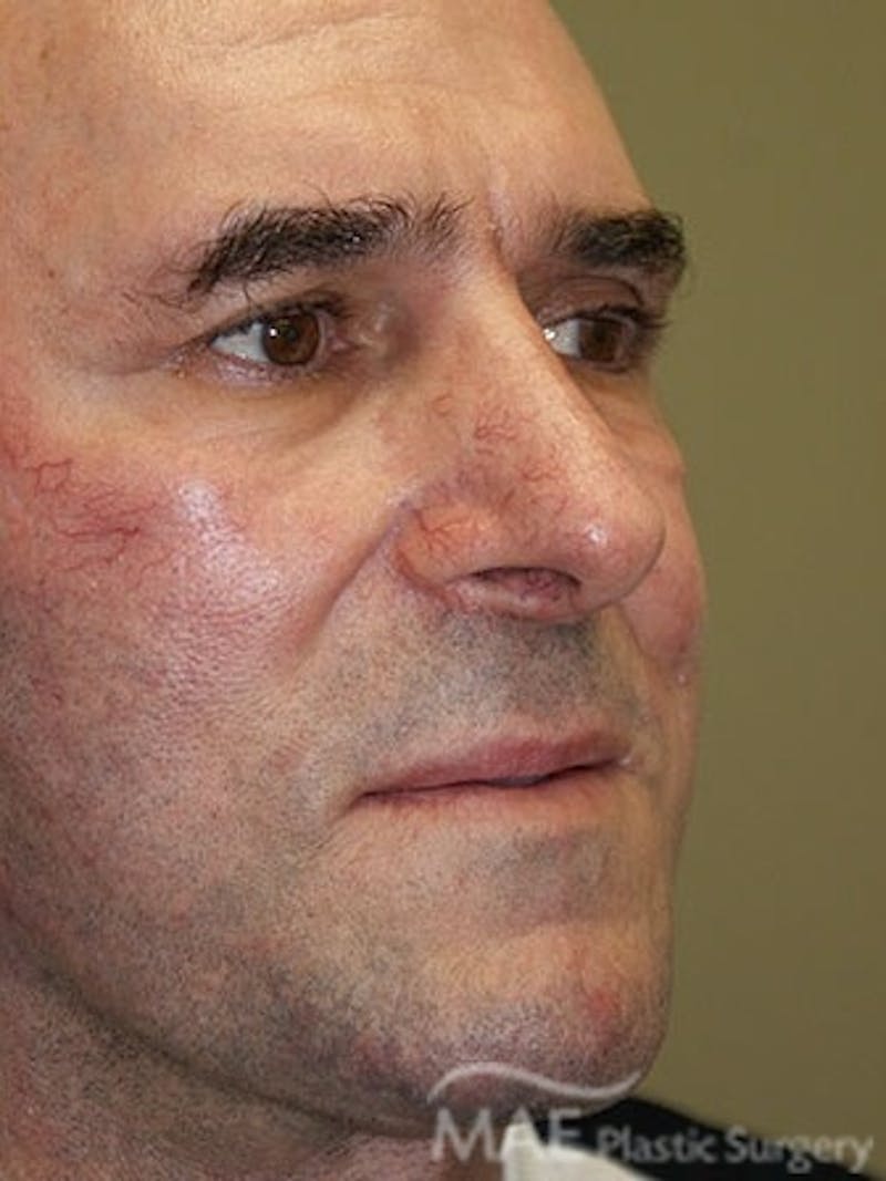 Facelift Before & After Gallery - Patient 127049 - Image 4