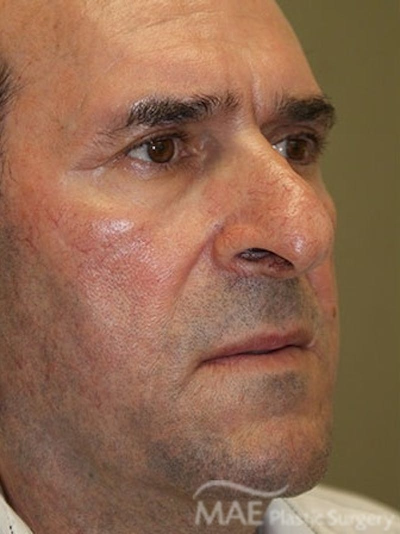 Facelift Before & After Gallery - Patient 127049 - Image 3