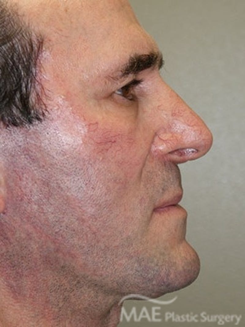 Facelift Before & After Gallery - Patient 127049 - Image 6
