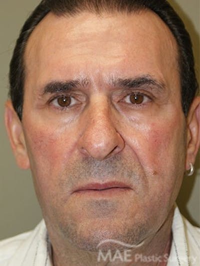 Facelift Before & After Gallery - Patient 127049 - Image 1