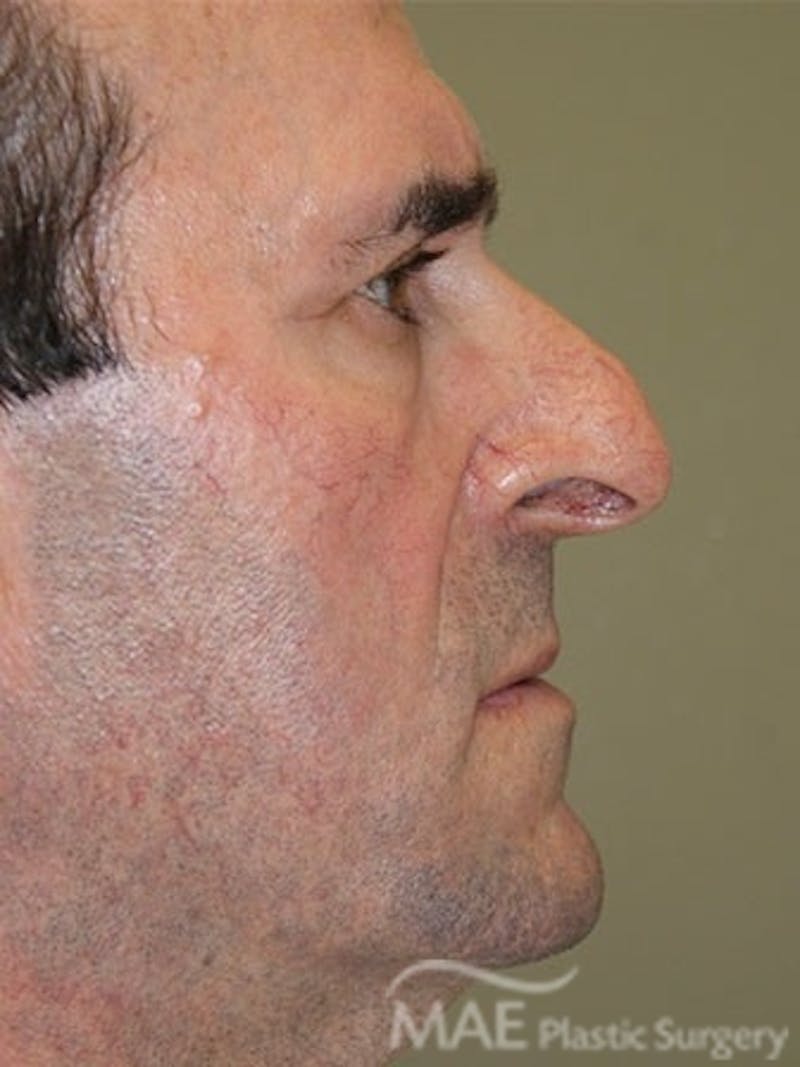 Facelift Before & After Gallery - Patient 127049 - Image 5