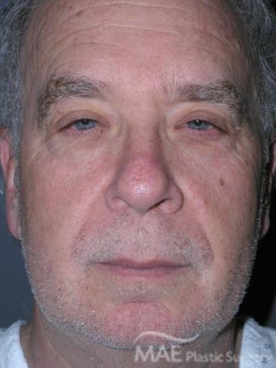 Facelift Before & After Gallery - Patient 258184 - Image 1