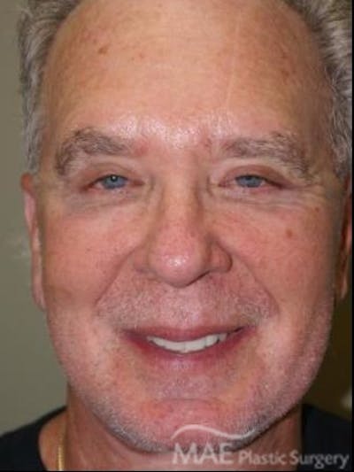 Facelift Before & After Gallery - Patient 258184 - Image 2
